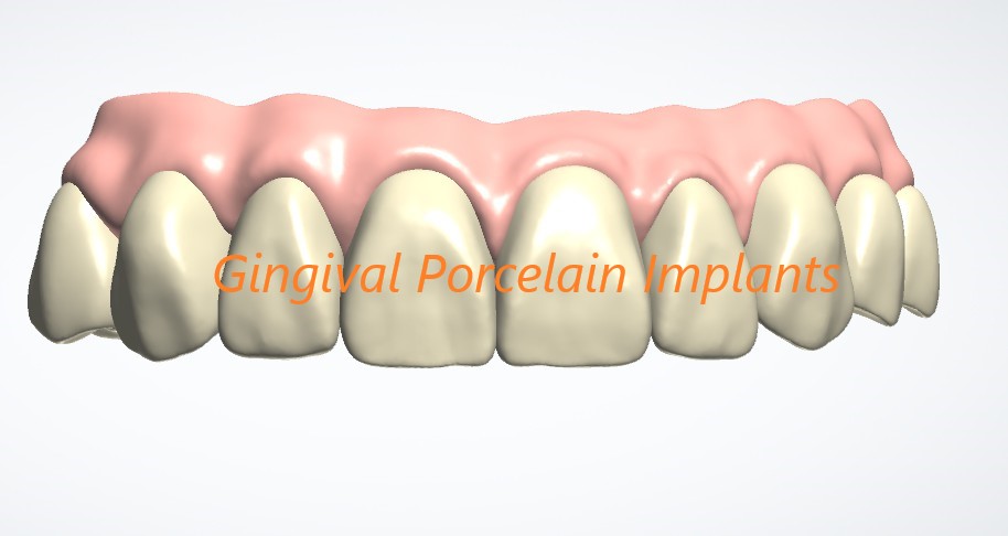 Gingival Porcelain Implants